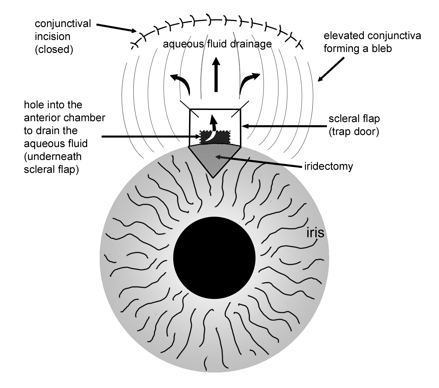 Trabeculectomy Surgery